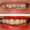 Smile Makeover: Porcelain Crowns, Denture, Gum Recontouring