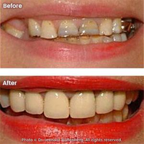 Smile Makeover: Porcelain Crowns, Denture, Gum Recontouring
