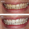 In-Office Tooth Whitening