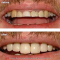 Smile Makeover: Crowns/Veneers and Dental Implants