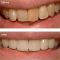 Smile Makeover: Porcelain/Ceramic Veneers and Tooth Whitening