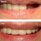 Dental Implant & Porcelain Bridge