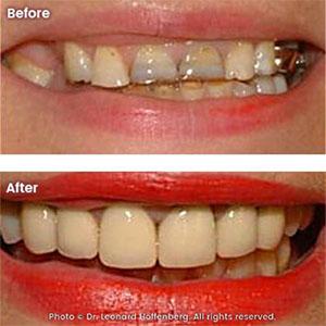teeth bonding TLC Dental Sydney