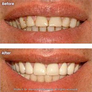 veneers before and after Sydney