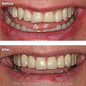veneer teeth TLC Dental Sydney 2000