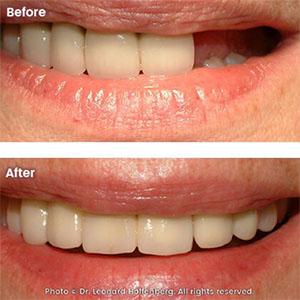 teeth whitening dentist TLC Dental Sydney 2000