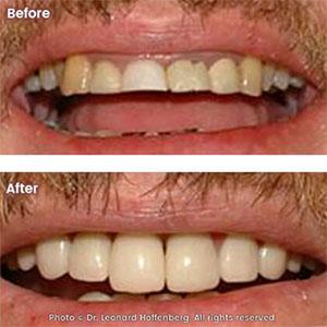 dental whitening TLC Dental