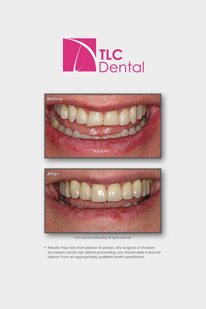 Orthodontic Treatment and Crowns