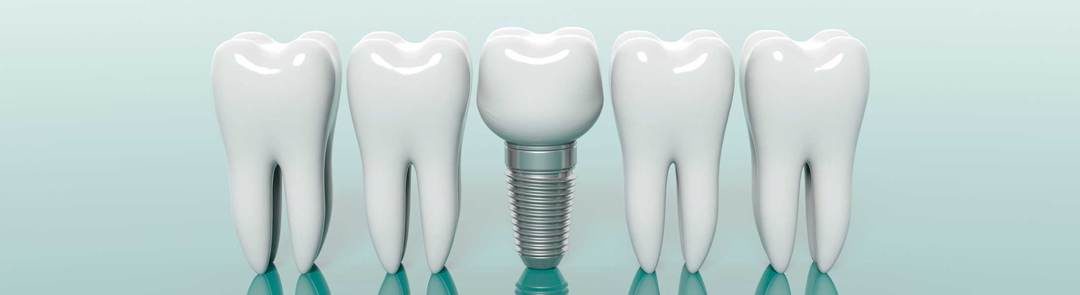dental implants questions from patients