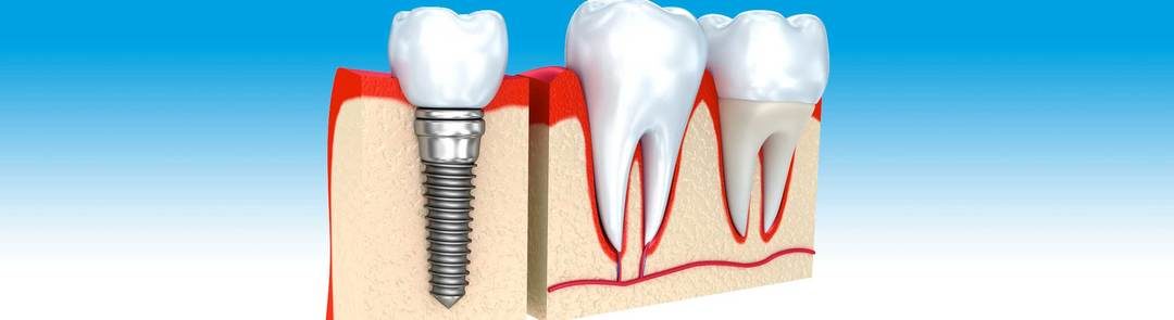 image showing how a dental implant looks