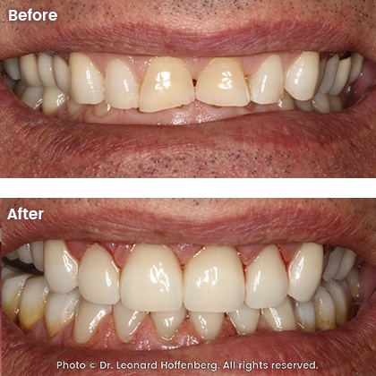 smile docs dr leonard hoffenberg sydney real results