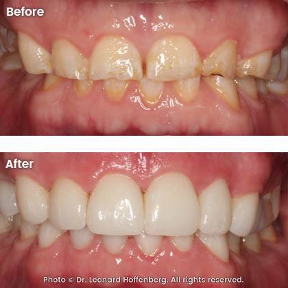 smile docs dr leonard hoffenberg sydney real results