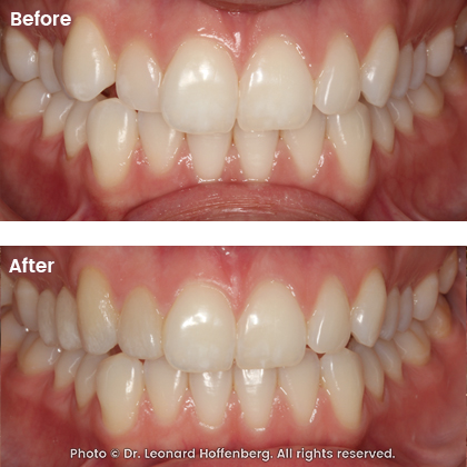 tlc dental dr leonard hoffenberg sydney real results