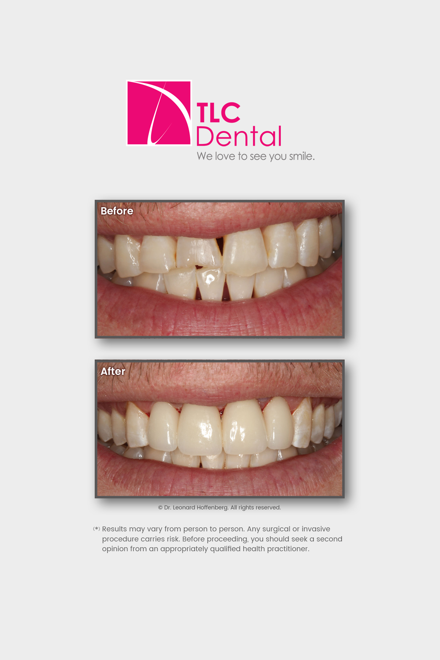 Smile Makeover: Ceramic Crowns, Gum Treatment and Orthodontics