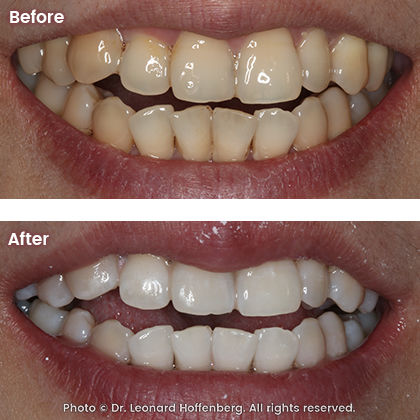 teeth after bleaching treatment